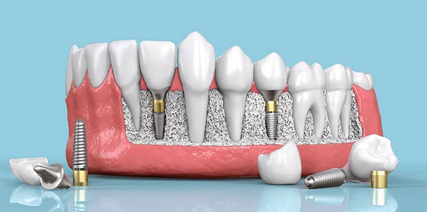 implantologia-clinica-odontoiatrica-giordano