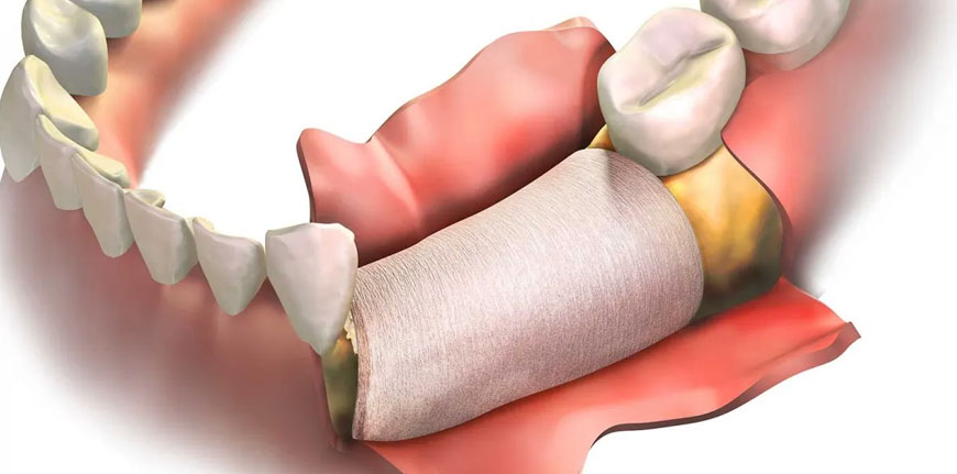 rigenerazione-ossea-clinica-odontoiatrica-giordano